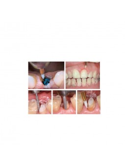 Easyinsmile Surgical bur special for soft Tissue