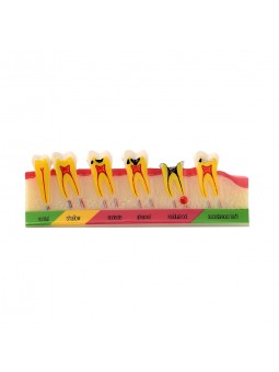 dental model teeth Easyinsmile Dental Caries Developing Model Tooth Typodont Model