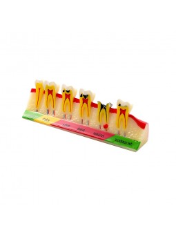 dental model teeth Easyinsmile Dental Caries Developing Model Tooth Typodont Model