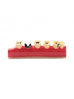 dental model teeth Easyinsmile Dental Caries Developing Model Tooth Typodont Model