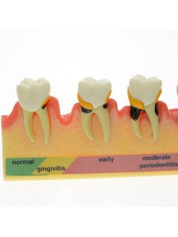 model teeth Easyinsmile Periodontal Disease Assort Tooth Typodont Model Study Teaching Model