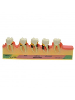 model teeth Easyinsmile Periodontal Disease Assort Tooth Typodont Model Study Teaching Model