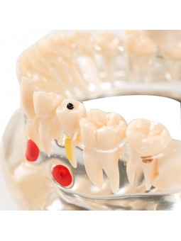 model of teeth Easyinsmile Half side can be removeble teeth model Patient & Student Education Teeth Model