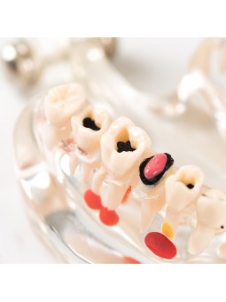 model of teeth Easyinsmile Half side can be removeble teeth model Patient & Student Education Teeth Model