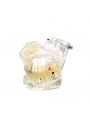 dental education models Easyinsmile Transparent Dental Implant Disease Removable Teeth Model Student Teaching Model