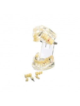 dental education models Easyinsmile Transparent Dental Implant Disease Removable Teeth Model Student Teaching Model