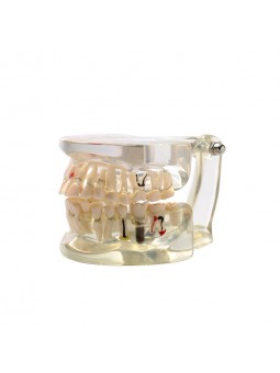 teeth models dental anatomy Easyinsmile Adult Teeth Model Pathological Dental Teaching Study Model