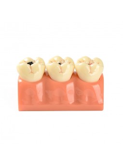 tooth anatomy model Easyinsmile 4 Times New Dental teeth model Patient Education Model Caries Disassembling model