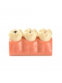 tooth anatomy model Easyinsmile 4 Times New Dental teeth model Patient Education Model Caries Disassembling model