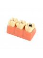 tooth anatomy model Easyinsmile 4 Times New Dental teeth model Patient Education Model Caries Disassembling model