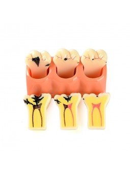 tooth anatomy model Easyinsmile 4 Times New Dental teeth model Patient Education Model Caries Disassembling model