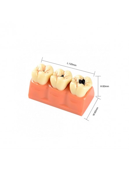 tooth anatomy model Easyinsmile 4 Times New Dental teeth model Patient Education Model Caries Disassembling model