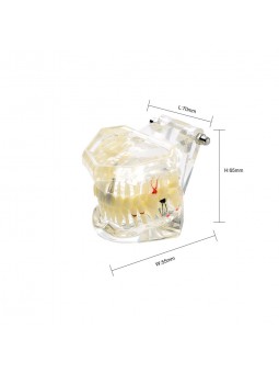 dental education models Easyinsmile Transparent Dental Implant Disease Removable Teeth Model Student Teaching Model