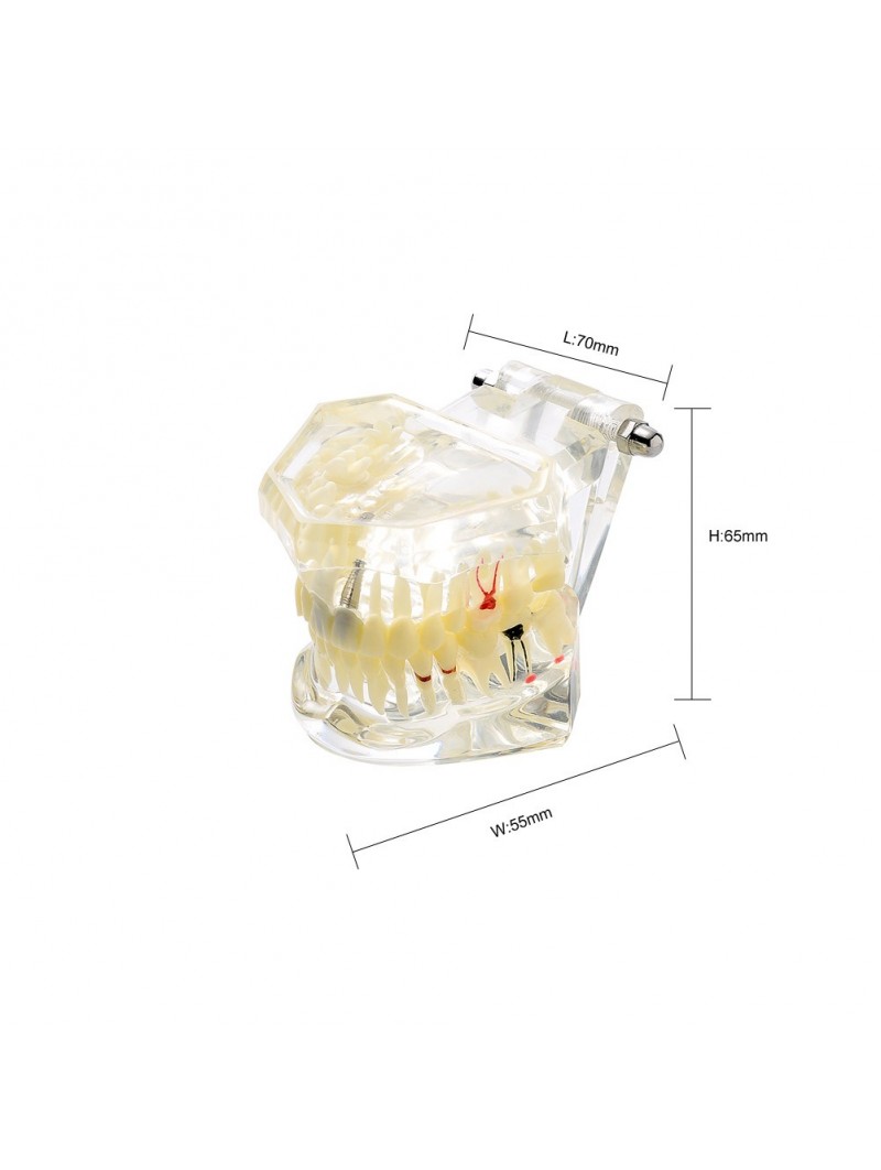 dental education models Easyinsmile Transparent Dental Implant Disease Removable Teeth Model Student Teaching Model