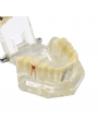 dental education models Easyinsmile Transparent Dental Implant Disease Removable Teeth Model Student Teaching Model