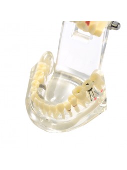 dental education models Easyinsmile Transparent Dental Implant Disease Removable Teeth Model Student Teaching Model