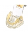 dental education models Easyinsmile Transparent Dental Implant Disease Removable Teeth Model Student Teaching Model