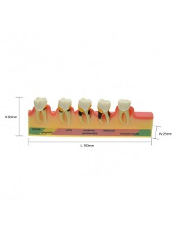 model teeth Easyinsmile Periodontal Disease Assort Tooth Typodont Model Study Teaching Model