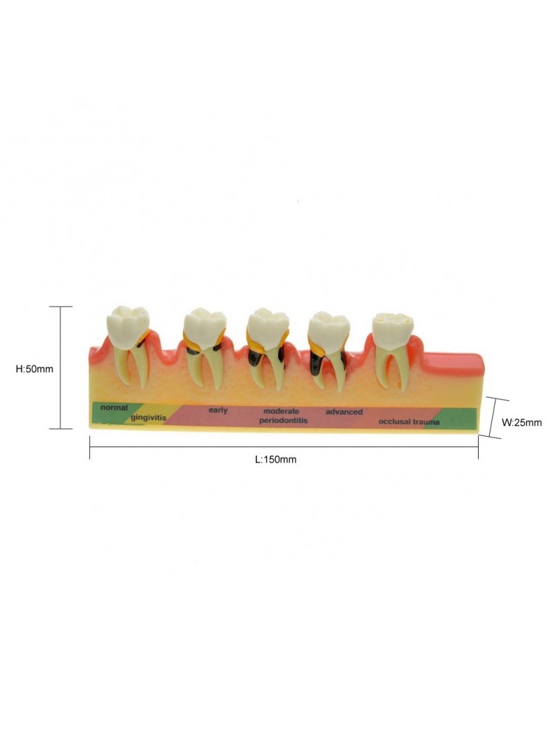 model teeth Easyinsmile Periodontal Disease Assort Tooth Typodont Model Study Teaching Model