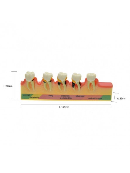 model teeth Easyinsmile Periodontal Disease Assort Tooth Typodont Model Study Teaching Model