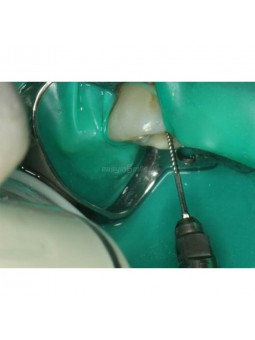Ultrasonic Files EASYINSMILE Dental NITI Endo U-File Tip Cleaning File for EMS/SATELEC Scaler