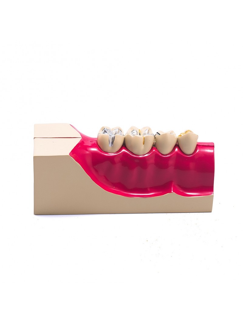 Dental teeth model of EASYINSMILE Disease Teeth Anatomy Study Model Molar Cross Section Model