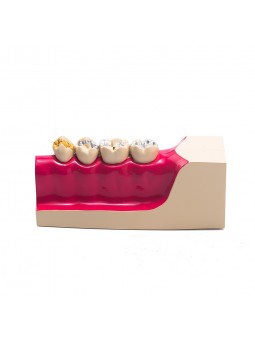 Dental teeth model of EASYINSMILE Disease Teeth Anatomy Study Model Molar Cross Section Model
