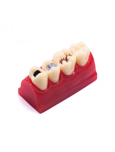 Tooth Model Of EASYINSMILE Dental Cavity Sealing Demonstration Tooth Model Inlay Teeth Model