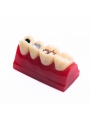 Tooth Model Of EASYINSMILE Dental Cavity Sealing Demonstration Tooth Model Inlay Teeth Model