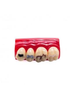 Tooth Model Of EASYINSMILE Dental Cavity Sealing Demonstration Tooth Model Inlay Teeth Model