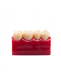 Tooth Model Of EASYINSMILE Dental Cavity Sealing Demonstration Tooth Model Inlay Teeth Model