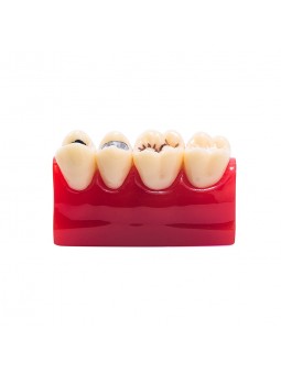 Tooth Model Of EASYINSMILE Dental Cavity Sealing Demonstration Tooth Model Inlay Teeth Model