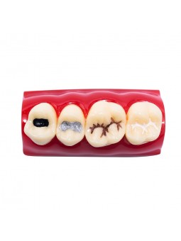 Tooth Model Of EASYINSMILE Dental Cavity Sealing Demonstration Tooth Model Inlay Teeth Model