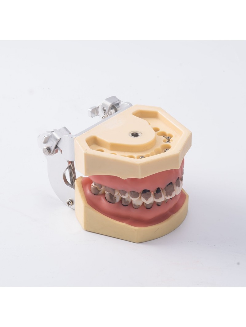 Teach Model 1Pcs Dental Teeth Periodontal Periodontitis Soft Gingivitis Study Lab Model EASYINSMILE