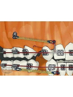 Dental Screw EASYINSMILE 1Pc Dental Implant Orthodontic MINI Titanium Micro Implant Screw