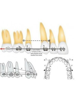 Dental Screw EASYINSMILE 1Pc Dental Implant Orthodontic MINI Titanium Micro Implant Screw 