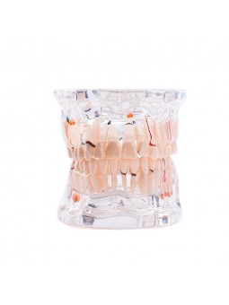 Dental Pathology Tooth Model EASYINSMILE Teeth Study Model With Half Implant