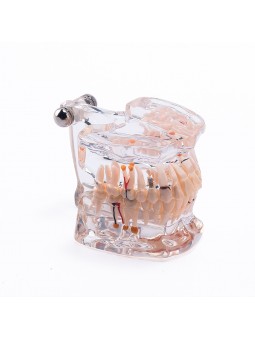 Dental Pathology Tooth Model EASYINSMILE Teeth Study Model With Half Implant