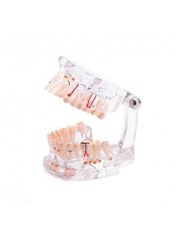 Dental Pathology Tooth Model EASYINSMILE Teeth Study Model With Half Implant