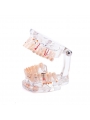 Dental Pathology Tooth Model EASYINSMILE Teeth Study Model With Half Implant