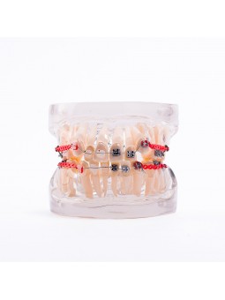  Dental Orthodontic Teeth Model Metal&Ceramic Brackets Contrast Model EASYINSMILE