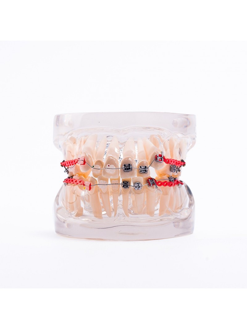  Dental Orthodontic Teeth Model Metal&Ceramic Brackets Contrast Model EASYINSMILE
