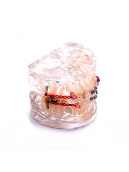 Dental Orthodontic Teeth Model Metal&Ceramic Brackets Contrast Model EASYINSMILE