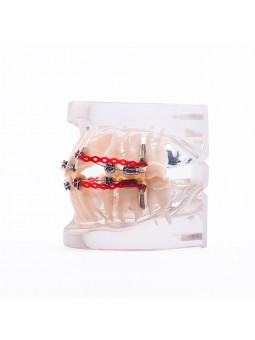  Dental Orthodontic Teeth Model Metal&Ceramic Brackets Contrast Model EASYINSMILE