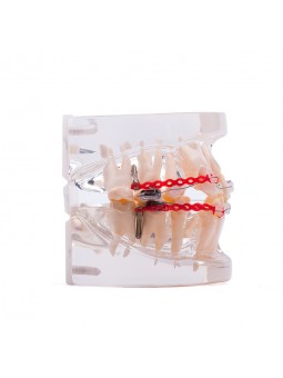  Dental Orthodontic Teeth Model Metal&Ceramic Brackets Contrast Model EASYINSMILE