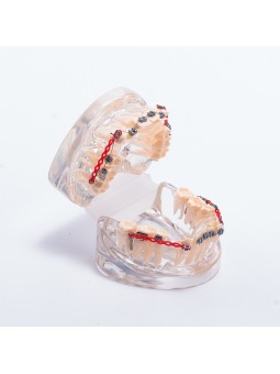 Dental orthodontic study teeth model Easyinsmile Metal brackets Archwires teeth model