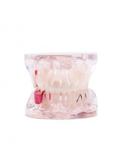 Dental Study Teeth Model Pathological Disease Demonstration Model EASYINSMILE 