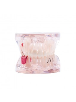 Dental Study Teeth Model Pathological Disease Demonstration Model EASYINSMILE