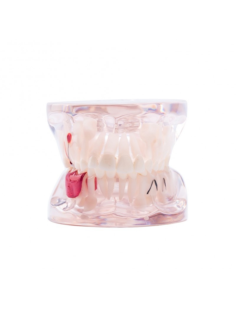 Dental Study Teeth Model Pathological Disease Demonstration Model EASYINSMILE 