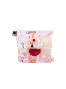 Dental Study Teeth Model Pathological Disease Demonstration Model EASYINSMILE 